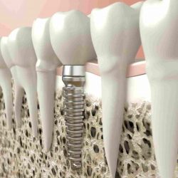 dantų atkūrimas implantais